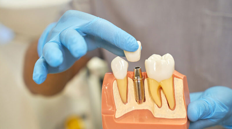 implante dental