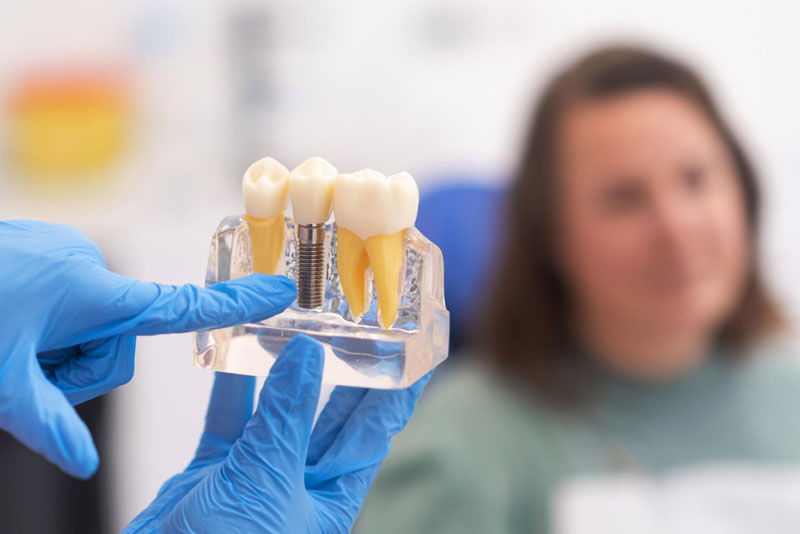 Implantes dentales en las Águilas Madrid