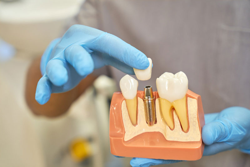 implante dental